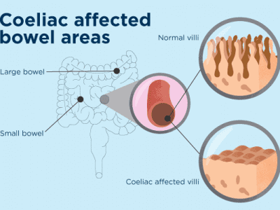 The Rise Of Coeliac Disease and the Need For Increased Knowledge on the Condition